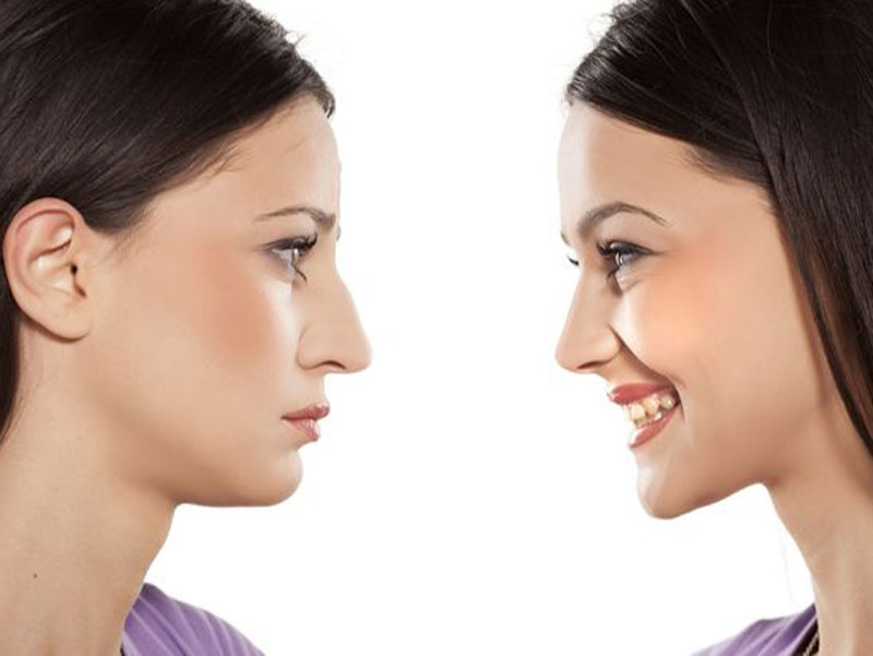 جراحة الأنف التجميلية ( أو رينوبلاستي )